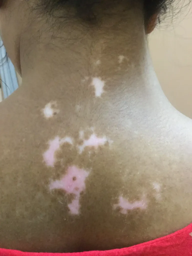 Vitiligo