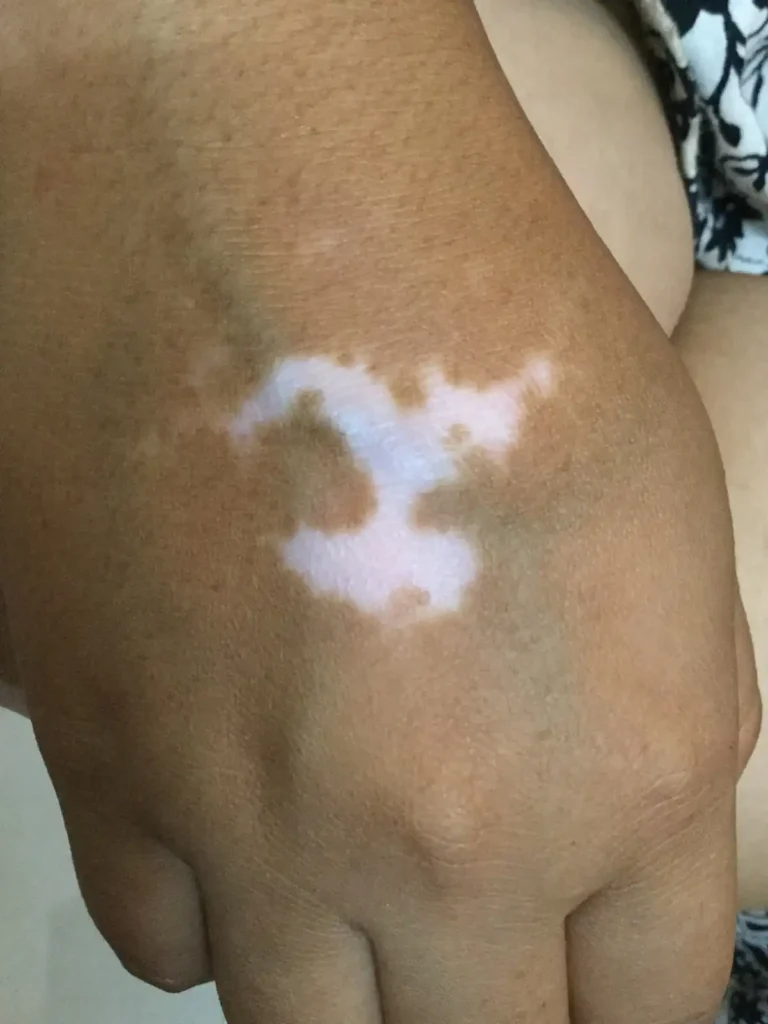 Vitiligo