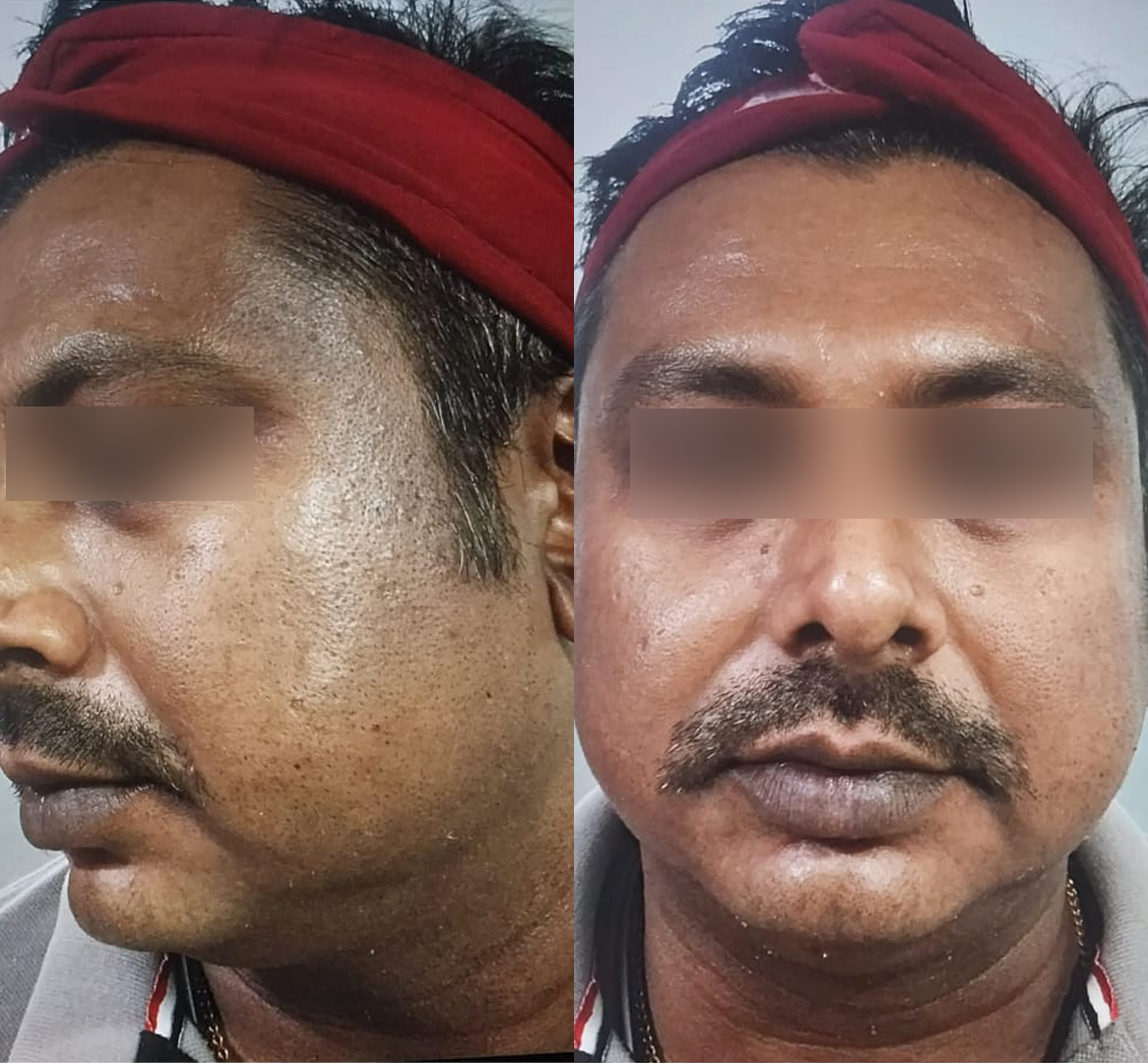 Vitiligo