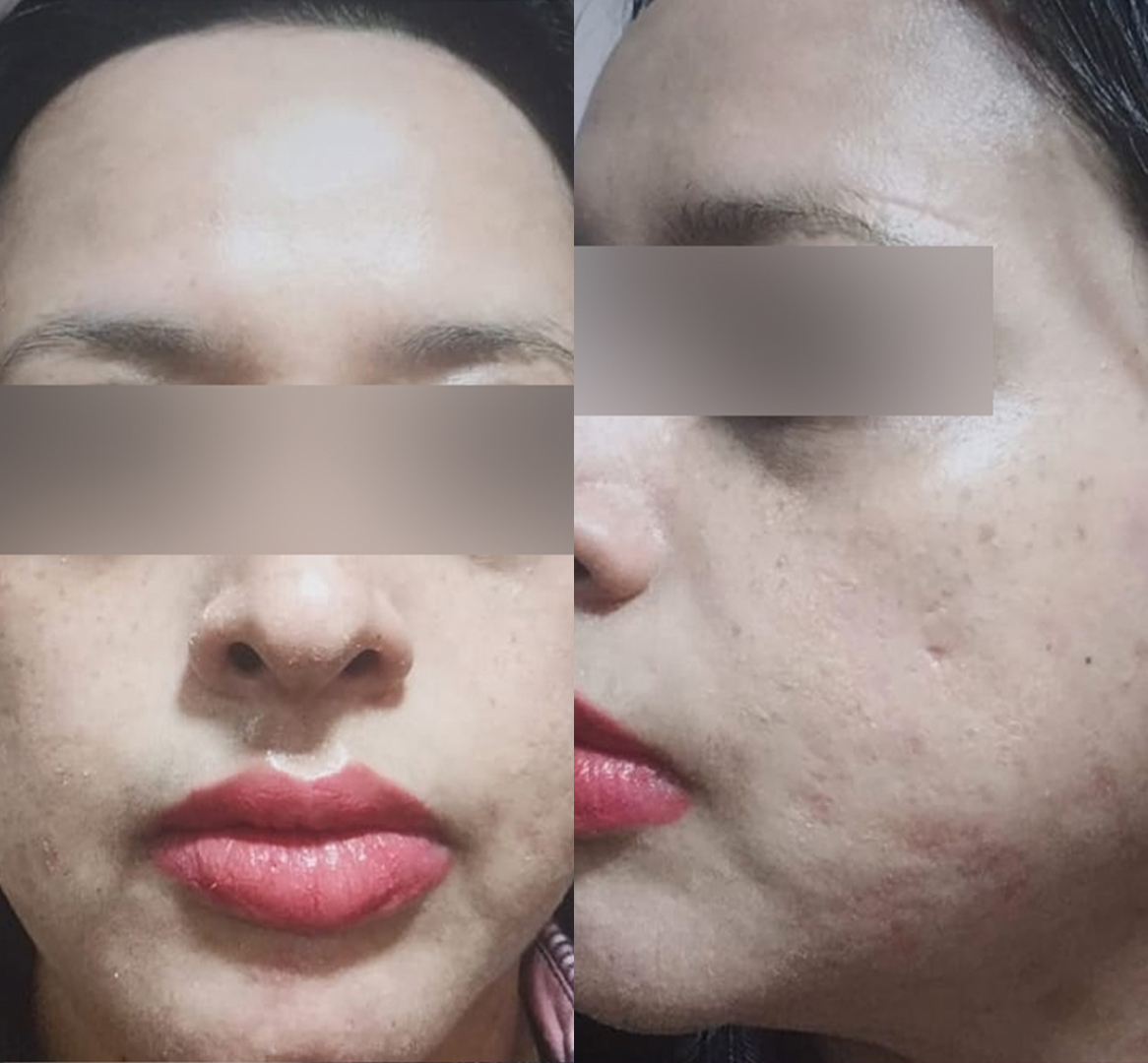 Vitiligo