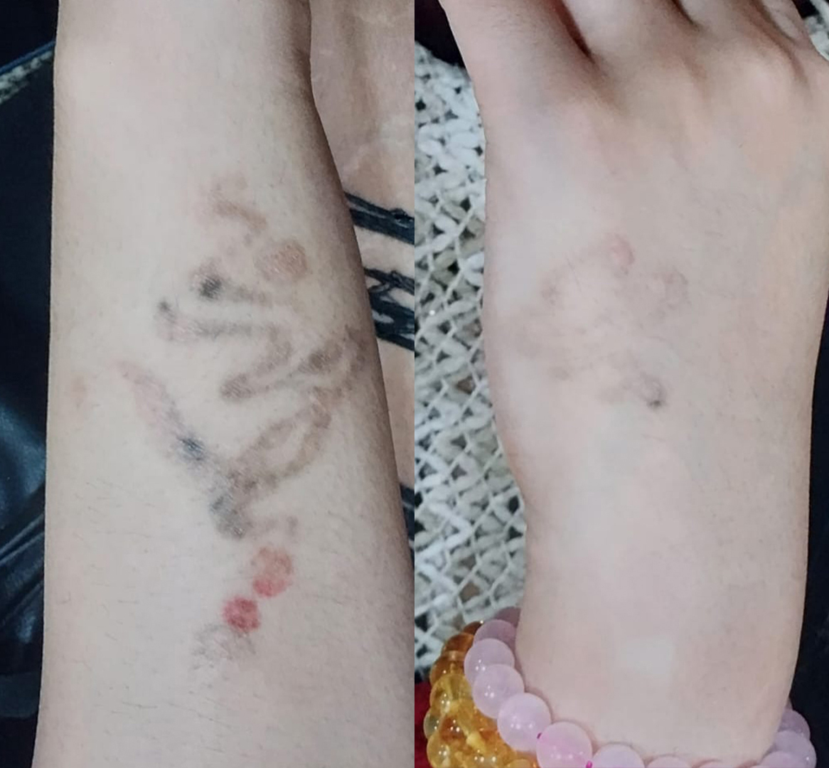 Vitiligo