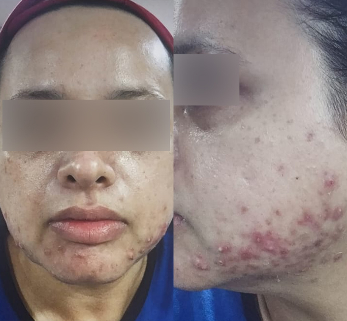 Vitiligo