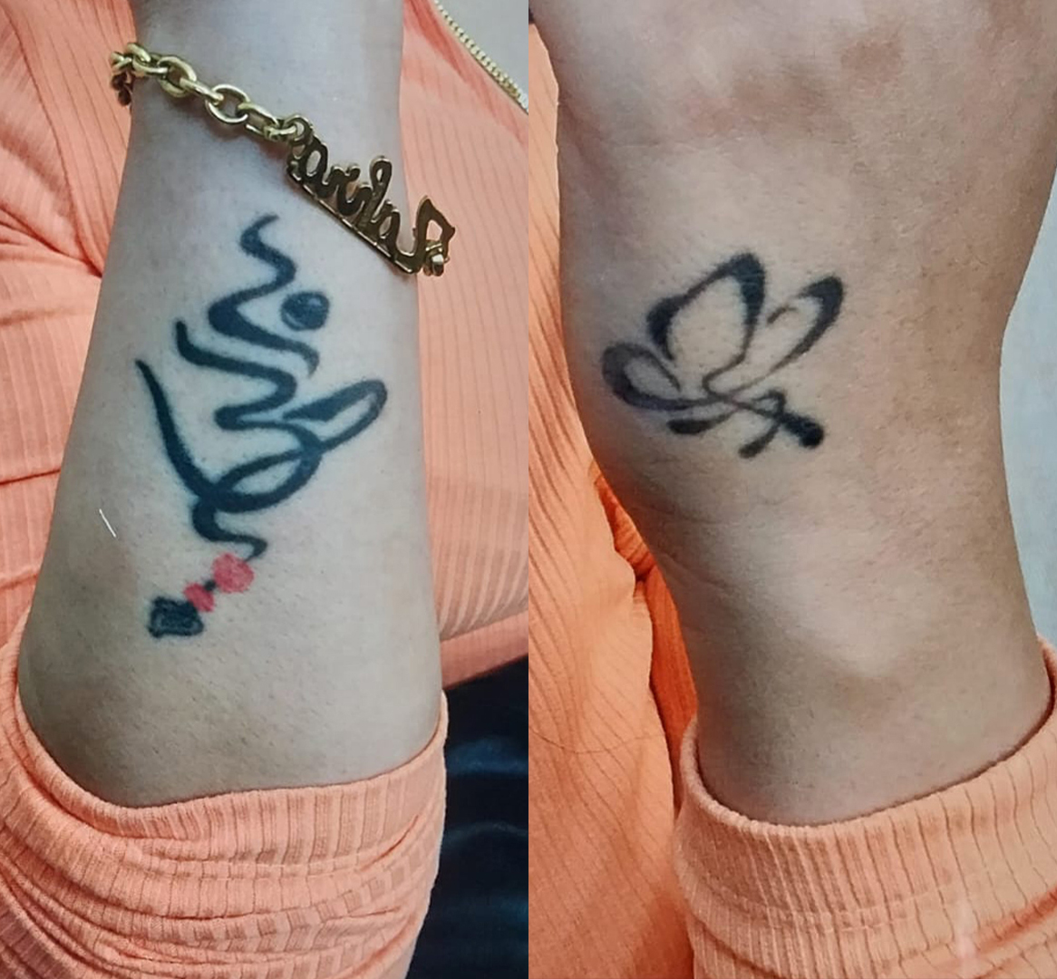 Vitiligo