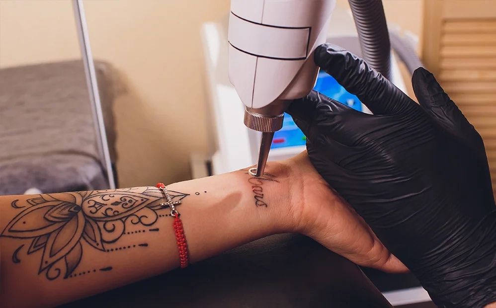 Tattoo Removal