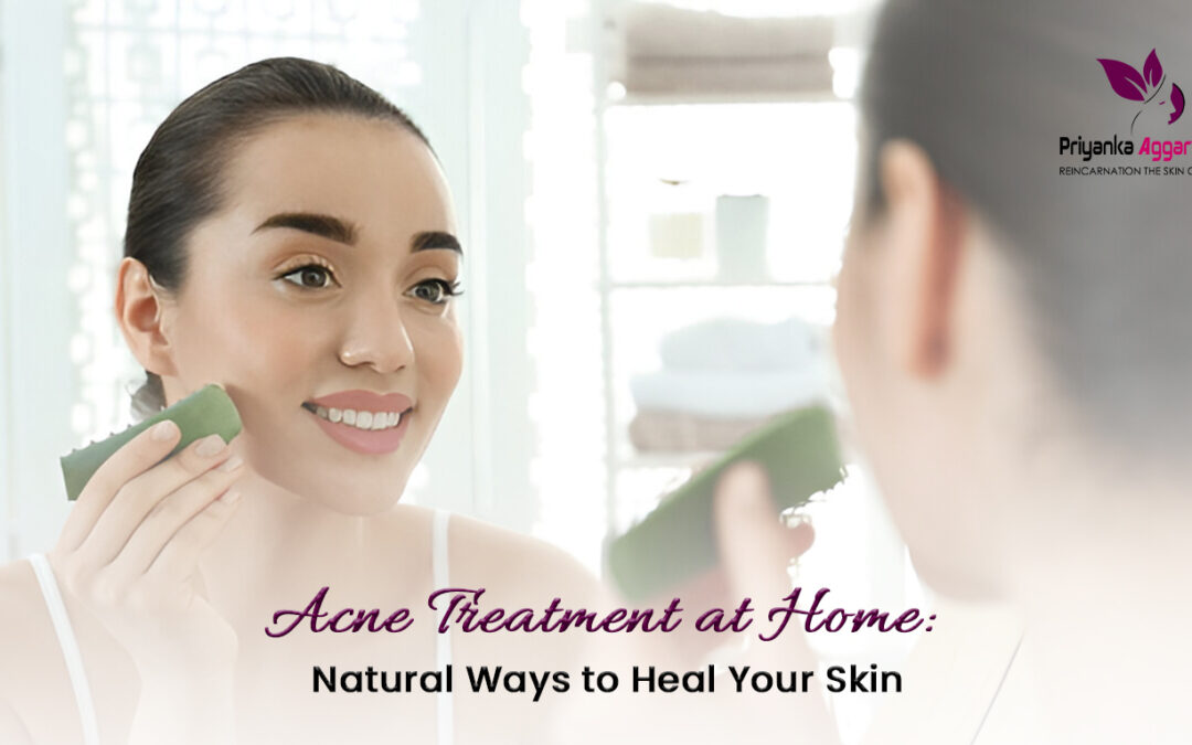 Acne Treatment at Home: Natural Ways to Heal Your Skin